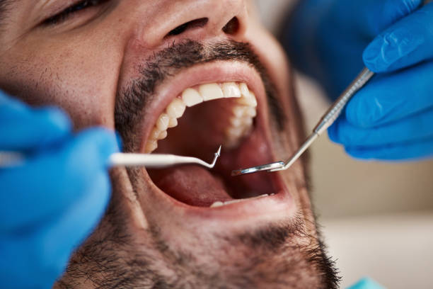 Best Emergency Treatment for Oral Infections in Mirrormont, WA